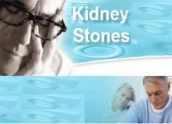 51 Tips for Dealing with Kidney Stones